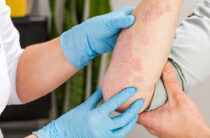 Современные методы лечения кожных заболеваний представили на форуме врачей в Таразе